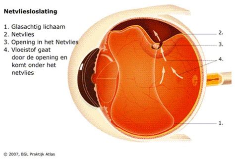 oog netvliesloslating